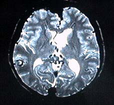 MRI T2WI image